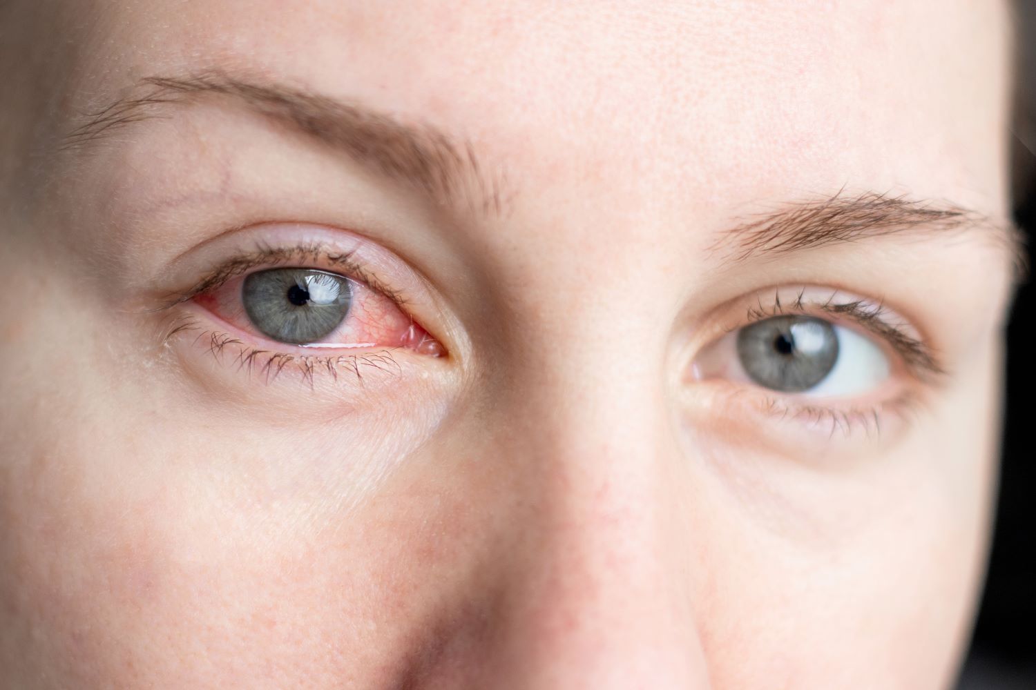 Die Nahaufnahme der Augen einer Frau. Die Bindehaut des einen Auges ist entzündet.