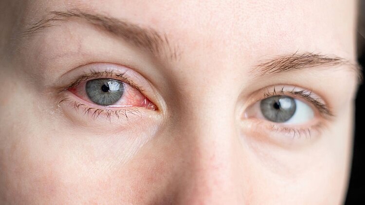 Die Nahaufnahme der Augen einer Frau. Die Bindehaut des einen Auges ist entzündet.